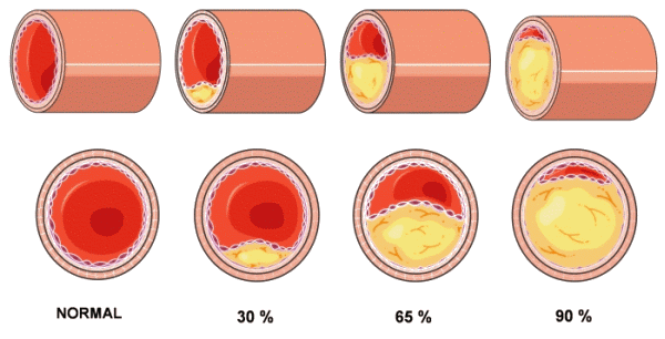 Schéma de calcification des artères