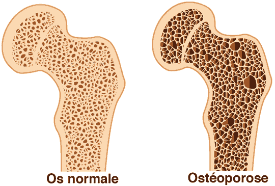 Ostéoporose