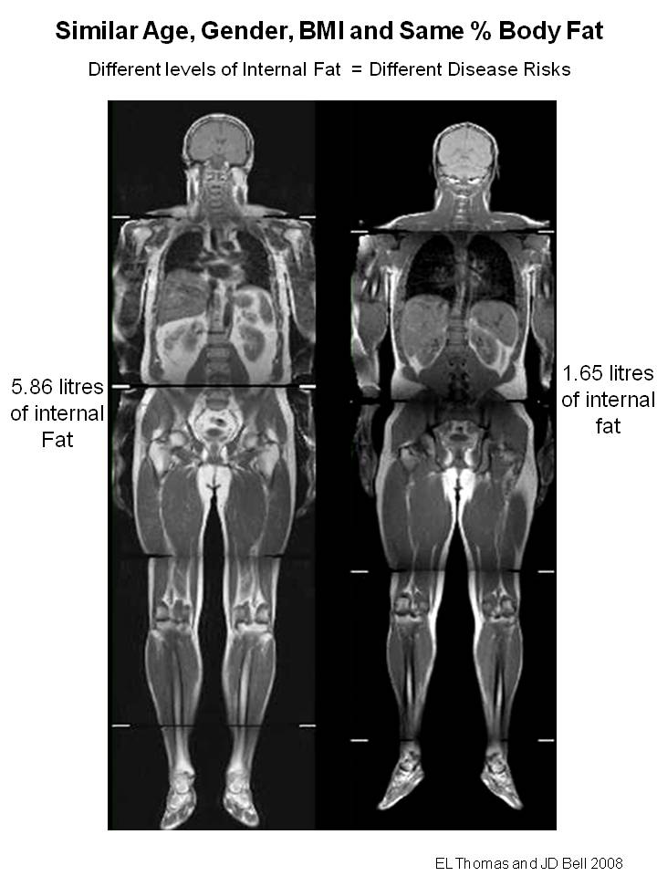 Schéma de deux images en coupe prise par IRM représentant deux hommes à la même corpulence, au même IMC et au même pourcentage de graisse corporelle. L'un d'entre eux a plus de graisse viscérale que l'autre.