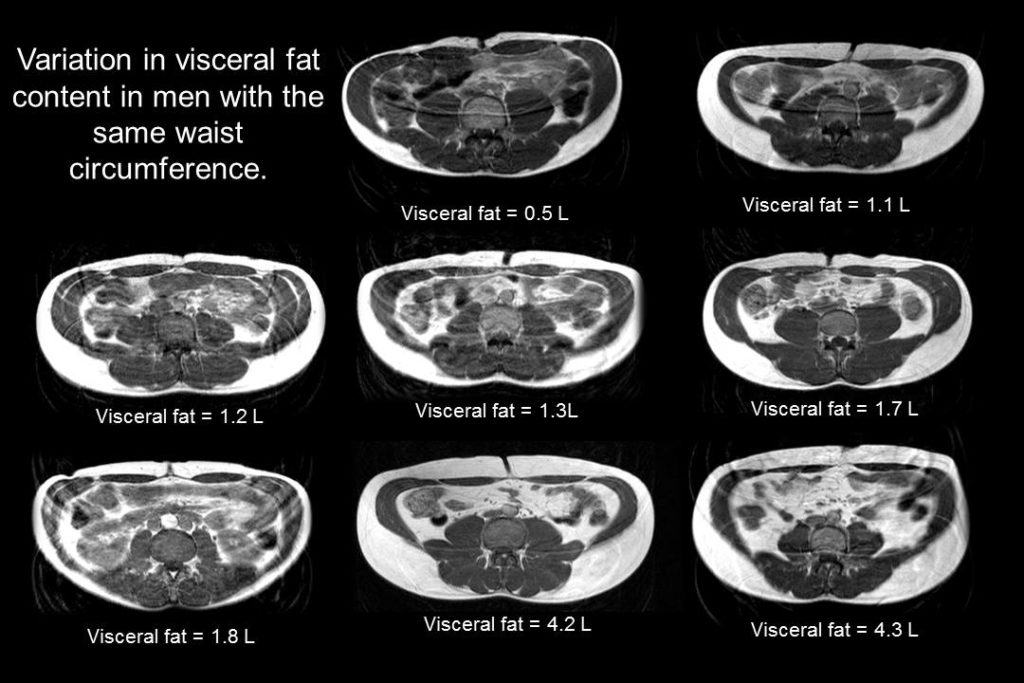 Schéma représentant une vue en coupe de 8 abdomens d'homme vus par IRM, présentant une taille identique mais une viariation dans la quantité de graisse viscérale et de graisse sous-cutanée qu'ils abritent.