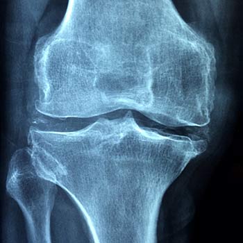 Radiographie d'une arthrose de genou : Comment supprimer les douleurs ?