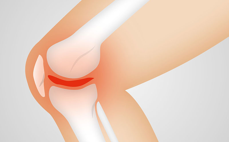 Arthrose : Schéma de l'articulation d'un genou touché par l'arthrose : le cartilage se dégrade et les inflammations créent des douleurs fortes