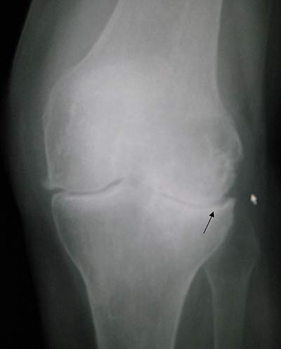 Arthrose : Radiographie d'une arthrose du genou. Le liquide synovial ne protège plus le cartilage qui se rétrécit, se fissure et finit par disparaître de manière anormale. Les os frottent alors les uns contre les autres.