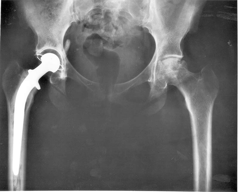 Arthrose : Radiographie d'une hanche ayant subi une opération chirurgicale de pose de prothèse sur le côté droit suite à un problème grave d'arthrose.
