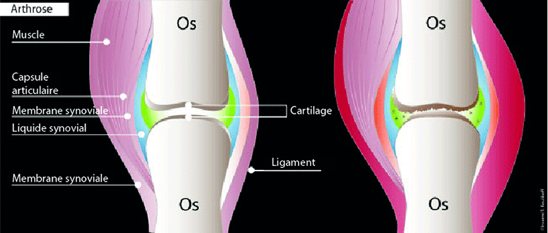 Arthrose : Schéma en couleur d'une articulation touchée par l'arthrose, comparée à une articulation saine sans inflammation des tendons ou de la membrane synoviale.